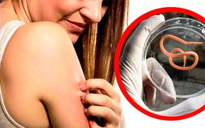 coceira e irritação devido a parasitas no corpo