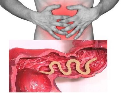 sinais de helmintíase crônica são distúrbio intestinal dispéptico